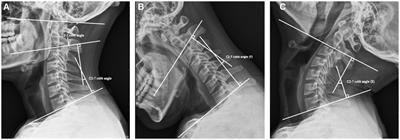 Posterior hybrid surgery for atlantoaxial dislocation coexisting with multilevel cervical spondylotic myelopathy